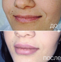 Аугментация губ, врач – Светлана